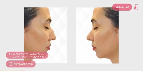 Rhinoplasty-type,-lifting-or-raising-and-creating-a-suitable-appearance-for-the-tip-of-the-nose