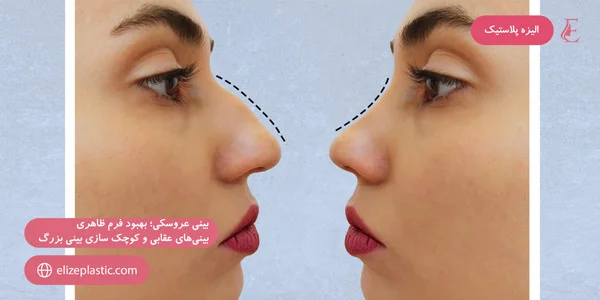 doll-nose;-Improving-the-appearance-of-eagle-noses-and-reducing-the-big-nose