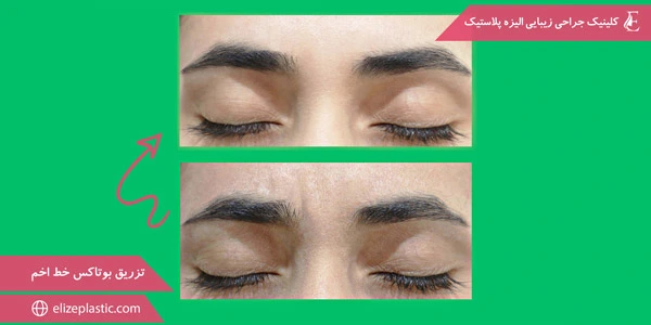 Botox-injections-for-frown-lines