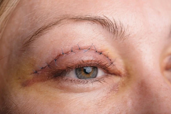 Blepharoplasty-scar