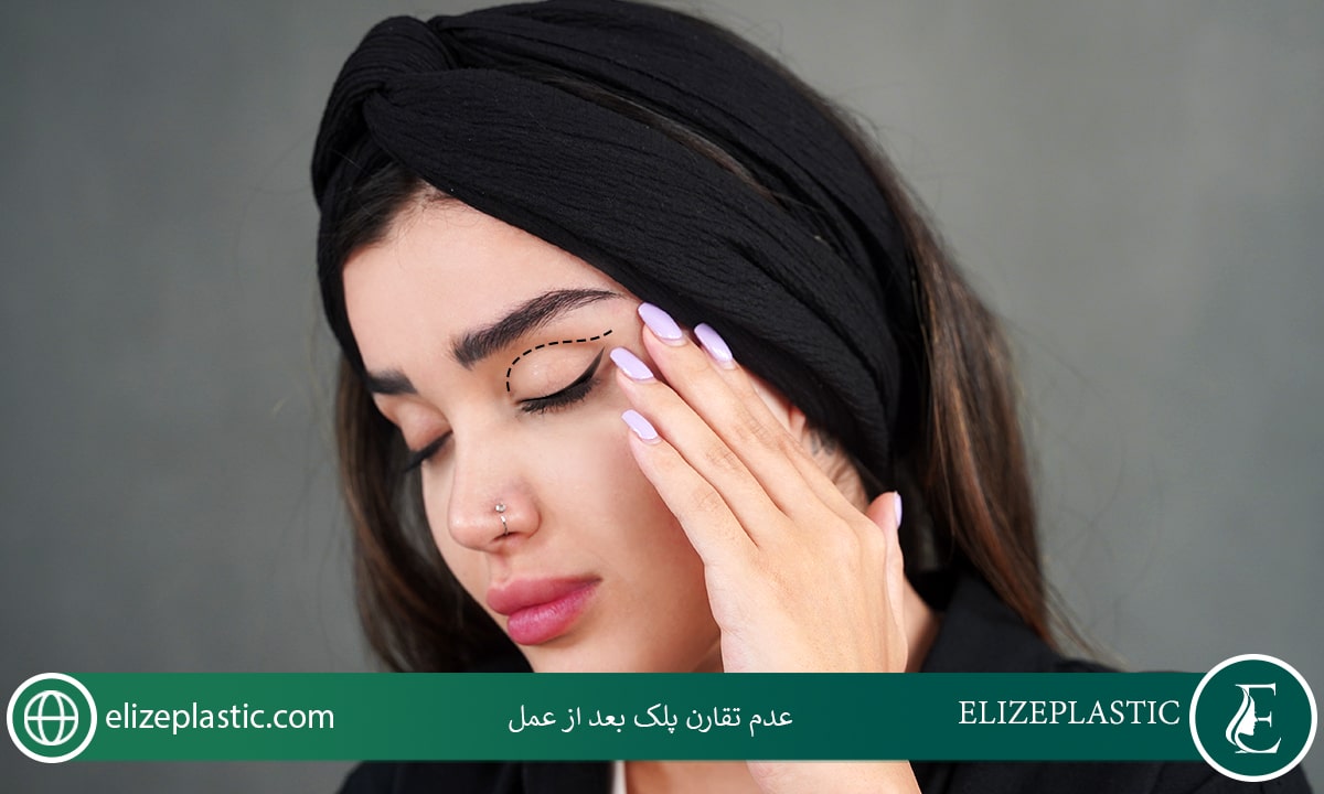 عدم تقارن پلک بعد از عمل 