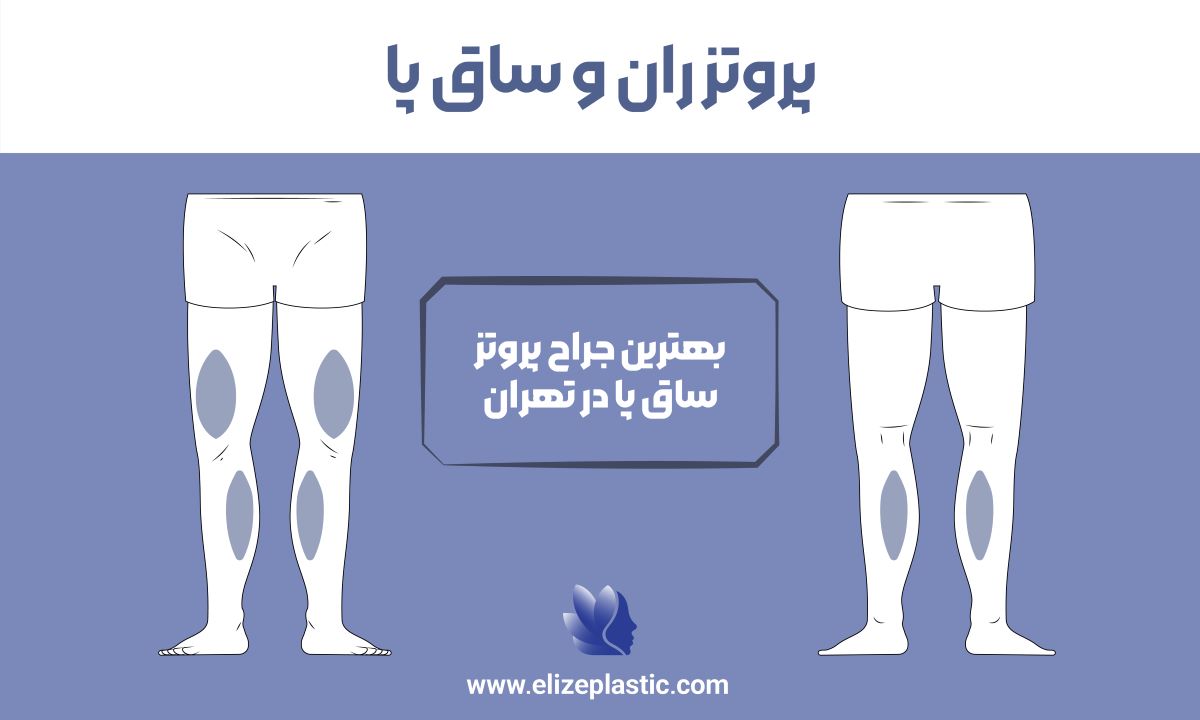 پروتز ران و ساق پا