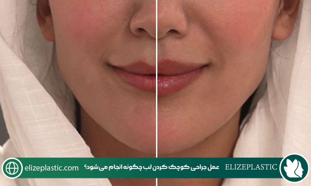 کوچک کردن لب 