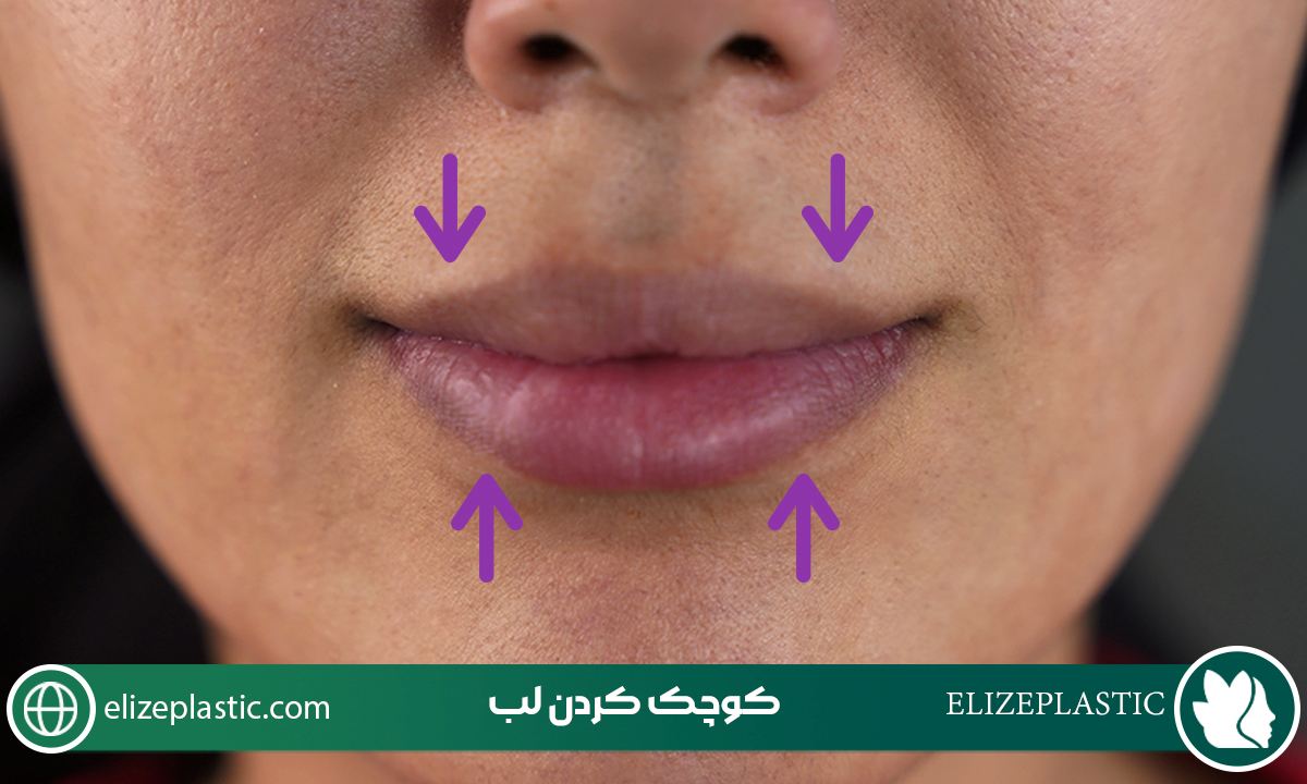 کوچک کردن لب 