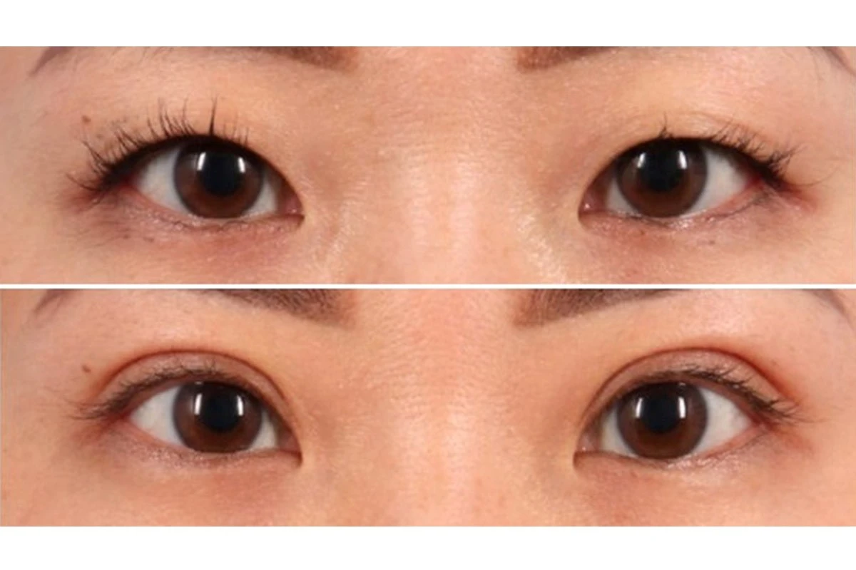 Second-eyelid-surgery