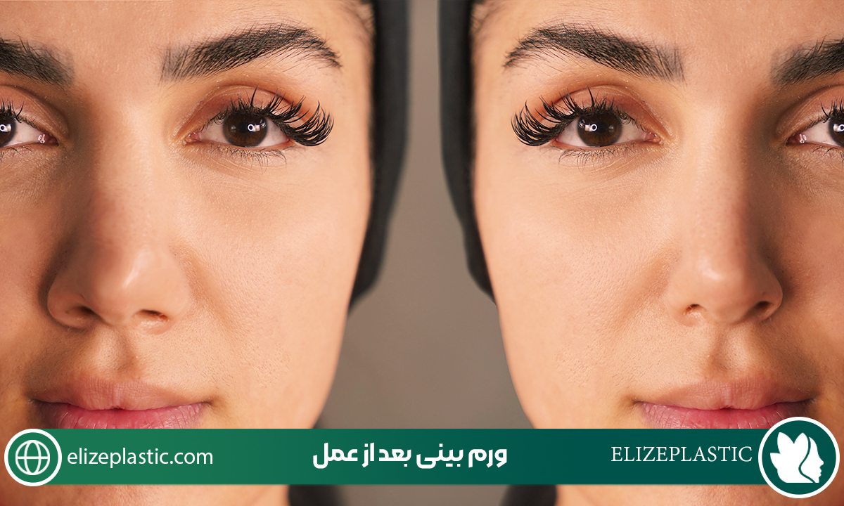  ورم بینی بعد از عمل‌‌‌