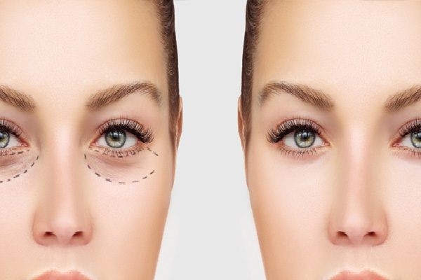 جراحی زیبایی چشم چیست و انواع جراحی زیبایی چشم