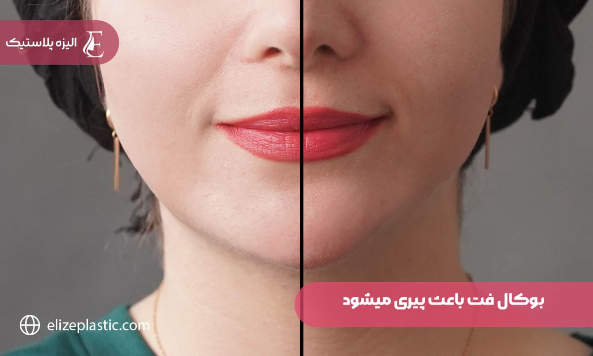 بوکال فت باعث پیری میشود