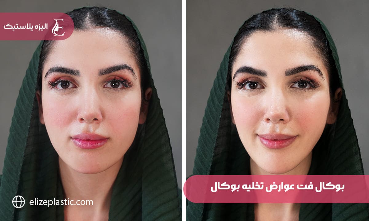 بوكال فت عوارض تخلیه چربی بوکال