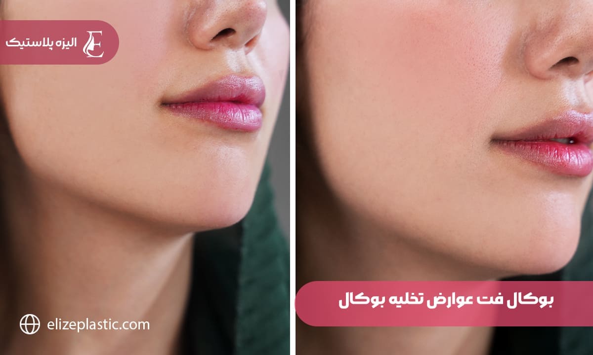 بوكال فت عوارض تخلیه چربی بوکال