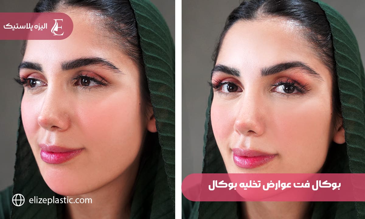 بوكال فت عوارض تخلیه چربی بوکال