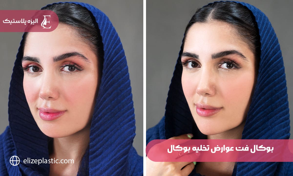 بوكال فت عوارض تخلیه چربی بوکال