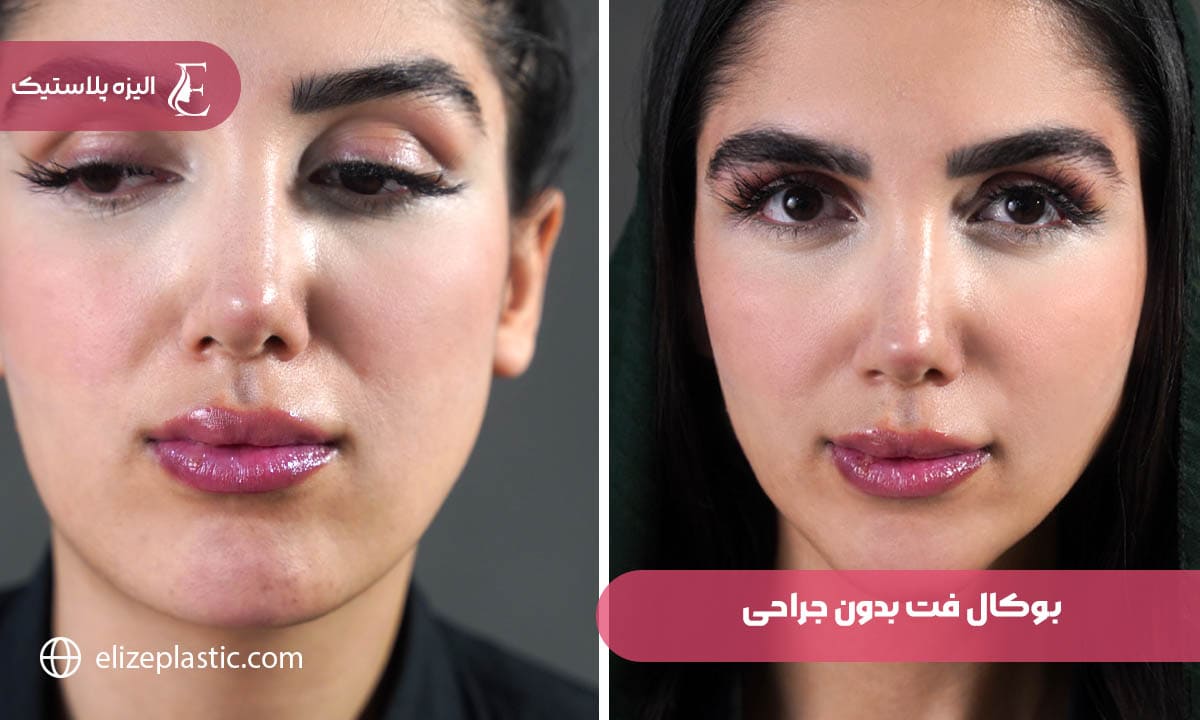 بوکال فت بدون جراحی