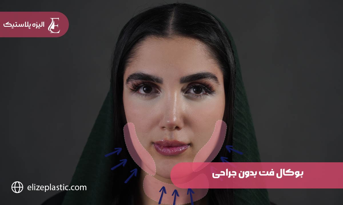 بوکال فت بدون جراحی