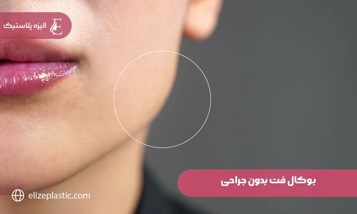 بوکال فت بدون جراحی