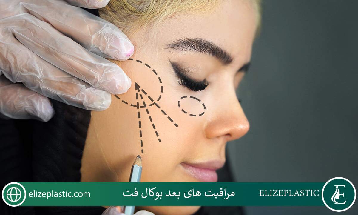  مراقبت‌های بعد از بوکال فت