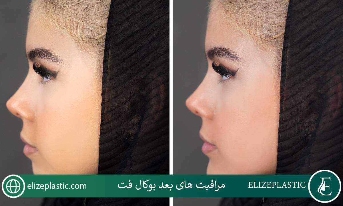  مراقبت‌های بعد از بوکال فت