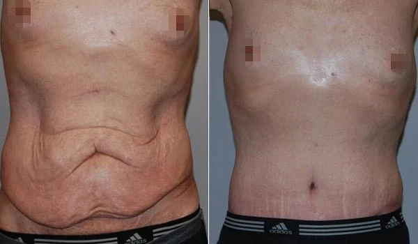 difference-body-contouring-abdominoplasty