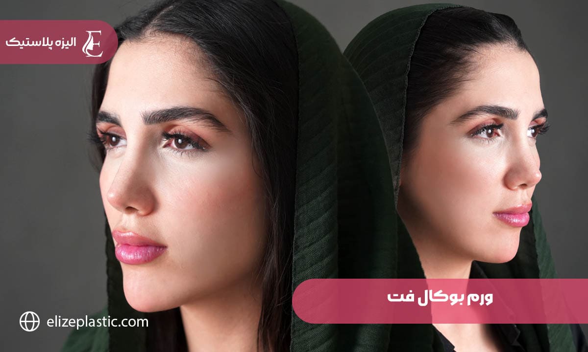  ورم بوکال فت