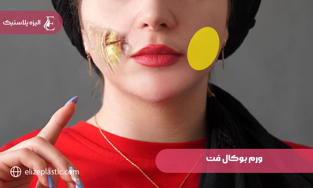  ورم بوکال فت