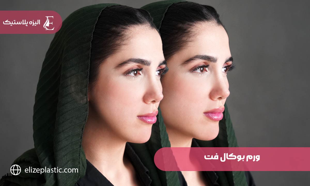  ورم بوکال فت
