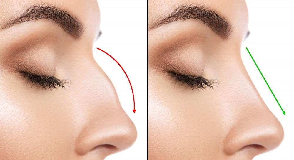 فرم اصلی بینی بعد از عمل کی مشخص میشود: آنچه باید بدانید